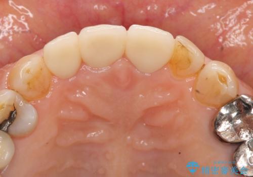 前歯の審美改善の治療後