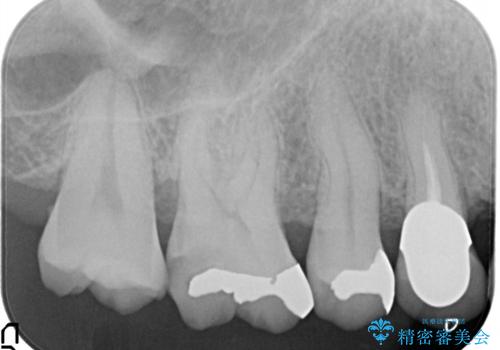 セラミッククラウンによるむし歯治療の治療前