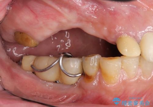 他院で中途半端に終わってしまったインプラント治療 の治療前