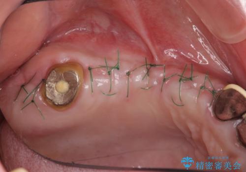 他院で中途半端に終わってしまったインプラント治療 の治療中