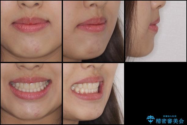 気になる前歯を審美歯科治療と矯正歯科治療で美しくの治療後(顔貌)