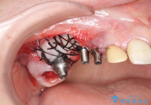 他院で中途半端に終わってしまったインプラント治療 の治療前