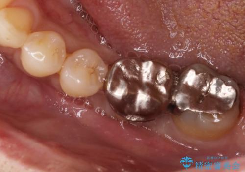見えない歯周病　長期予後を見据えてインプラントにの治療前