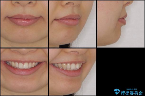 口が閉じにくい 1本飛び出した前歯の矯正治療の治療前(顔貌)