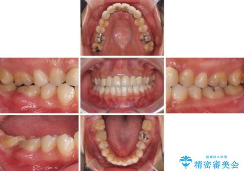 気になる前歯を審美歯科治療と矯正歯科治療で美しくの治療前