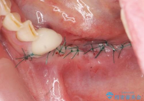 歯を失い噛めない、インプラントによる咬合機能回復の治療中