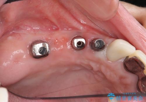 他院で中途半端に終わってしまったインプラント治療 の治療中