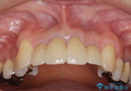 歯茎の黒ずみがきになる　前歯の見た目を改善したいの治療後