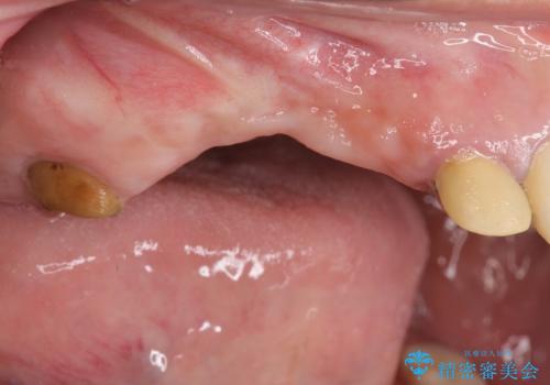 他院で中途半端に終わってしまったインプラント治療　の症例 治療前