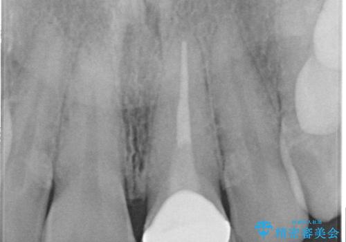 前歯のメタルをセラミックにしたい 歯自体が変色している場合の参考用の治療後
