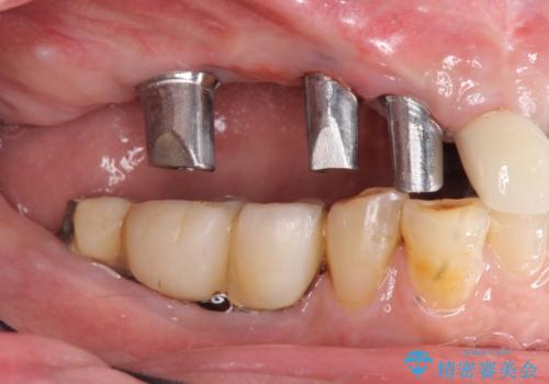 他院で中途半端に終わってしまったインプラント治療 の治療中
