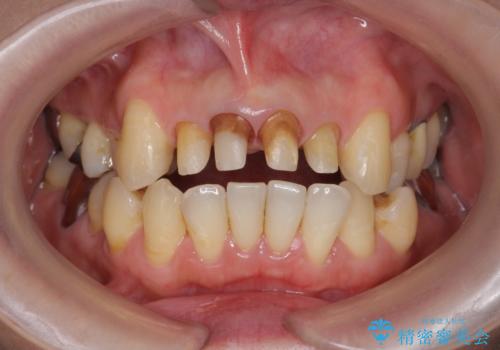 歯茎の黒ずみがきになる　前歯の見た目を改善したいの治療中