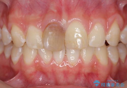 前歯をきれいにしたい ジルコニアクラウンによる審美治療の治療前