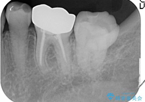 [金属の詰め物内部にむし歯] 奥歯のセラミックインレーの治療後