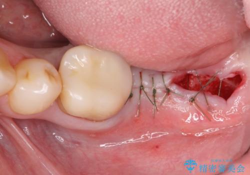 最後方臼歯のインプラント補綴の治療中