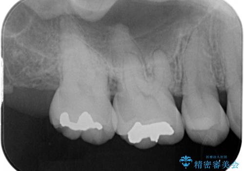 むし歯の治療。ゴールドインレーによる修復の治療前