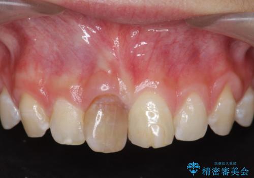 前歯をきれいにしたい ジルコニアクラウンによる審美治療の症例 治療前