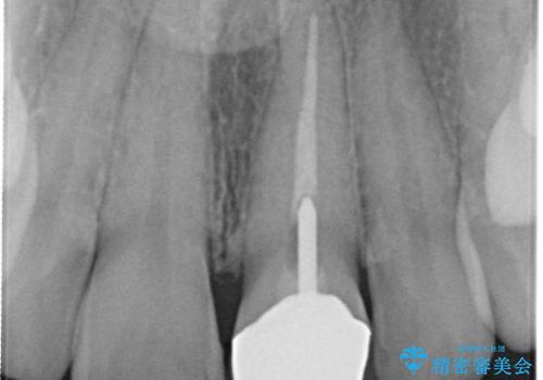 前歯のメタルをセラミックにしたい　歯自体が変色している場合の参考用の治療前