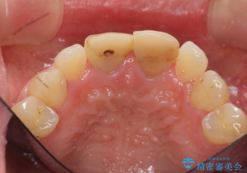 短期集中  前歯審美治療の治療前