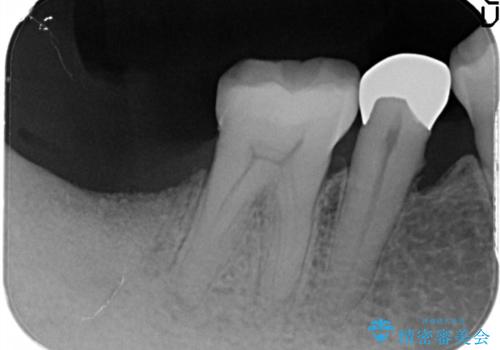 奥歯が痛い。骨増生を併用したインプラントの治療後