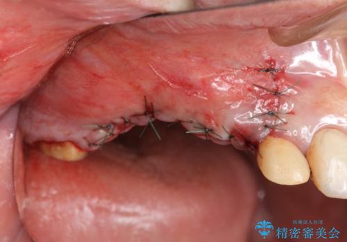 他院で中途半端に終わってしまったインプラント治療 の治療前