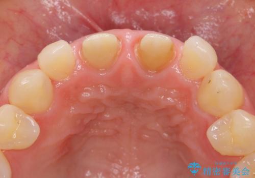 短期集中  前歯審美治療の治療中