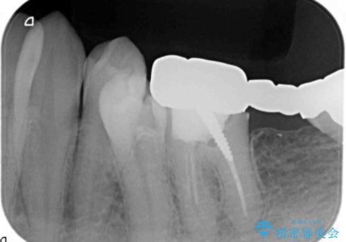 最後方臼歯のインプラント補綴の治療前