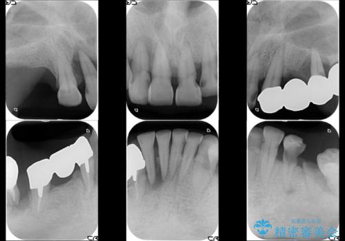 虫歯だらけ、歯周病 崩壊した口腔の再建 フルマウスリコンストラクションの治療前