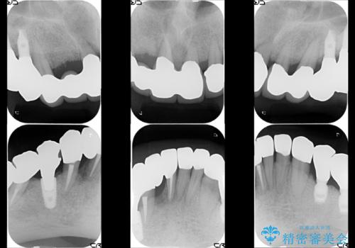 虫歯だらけ、歯周病 崩壊した口腔の再建 フルマウスリコンストラクションの治療後