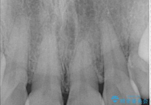昔ぶつけた前歯 つめもの変色の治療前