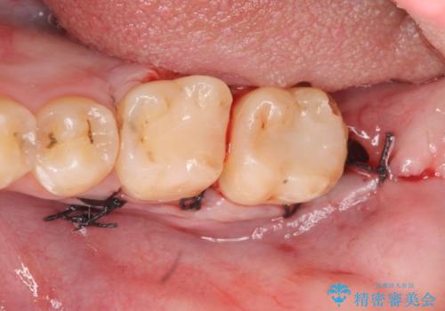 歯冠長延長術を併用した審美的セラミック治療の治療後