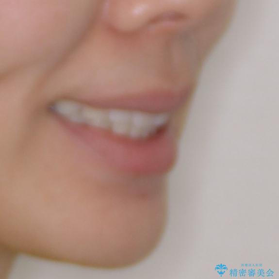 矯正治療の後戻りをインビザライン・ライトで改善の治療後(顔貌)