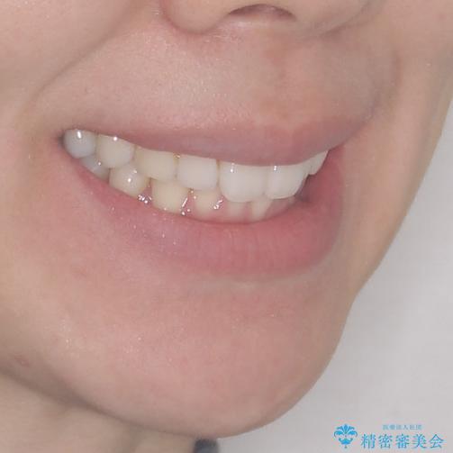 矯正治療の後戻りをインビザライン・ライトで改善の治療前(顔貌)