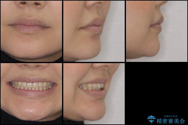 インビザラインによるディープバイトの改善の治療後(顔貌)