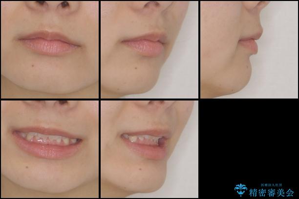 インビザラインによる前歯の矯正治療の治療後（顔貌）
