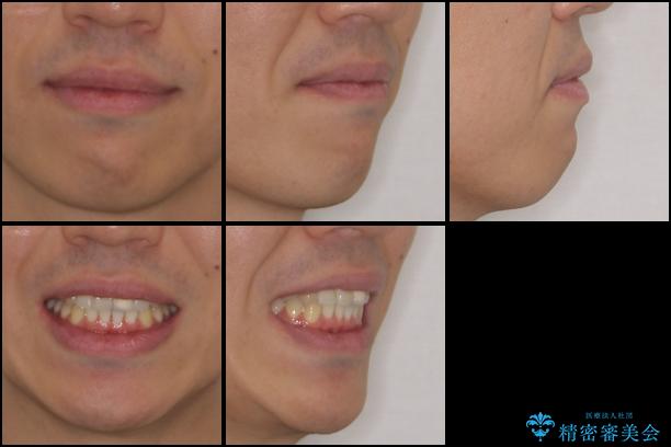前歯の歯並びとクラウンを改善　インビザラインとオールセラミックの治療後（顔貌）