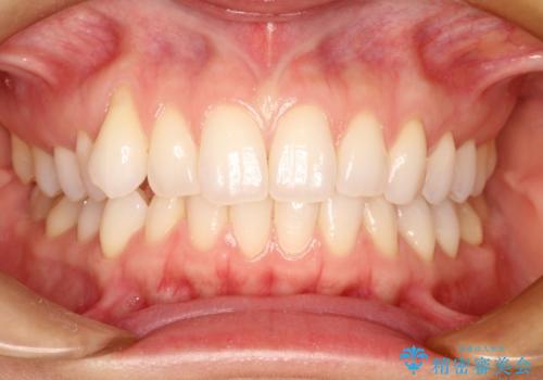八重歯をマウスピース矯正で治療し、レーザーホワイトニングを行った症例の治療前