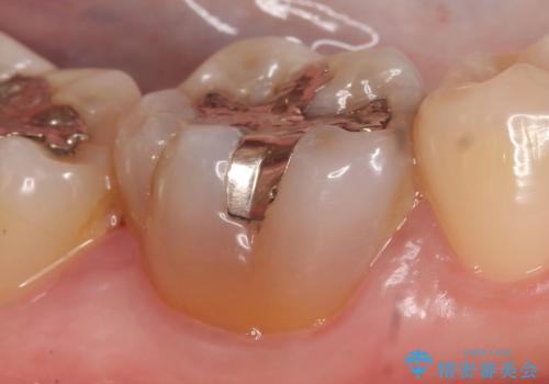 セラミックインレー 虫歯治療の治療前