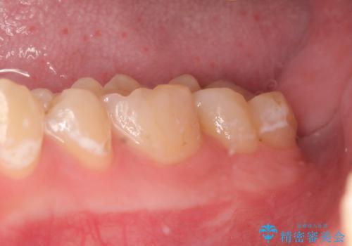 歯冠長延長術を併用した審美的セラミック治療の治療前