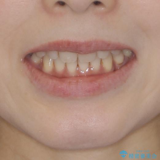 軽度な歯列不正　インビザライン・ライトによる矯正治療の治療後（顔貌）