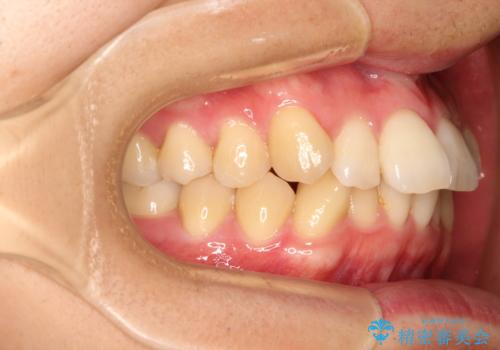 前歯の凸凹をきれいにしたい。インビザラインによる治療の治療前