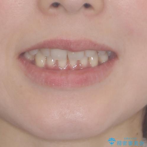 軽度な歯列不正 インビザライン・ライトによる矯正治療の治療前(顔貌)