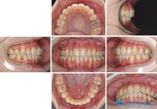 軽度な歯列不正 インビザライン・ライトによる矯正治療の治療後