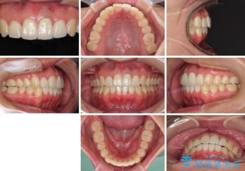 前歯の歯並びとクラウンを改善 インビザラインとオールセラミックの治療後