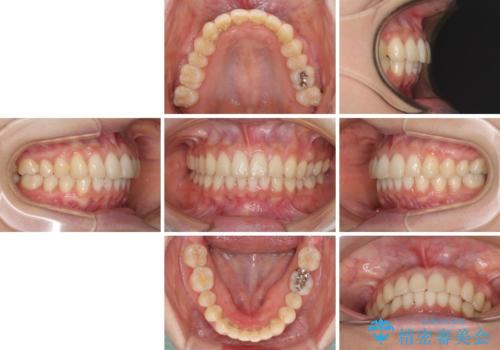 インビザラインによるディープバイトの改善の治療後