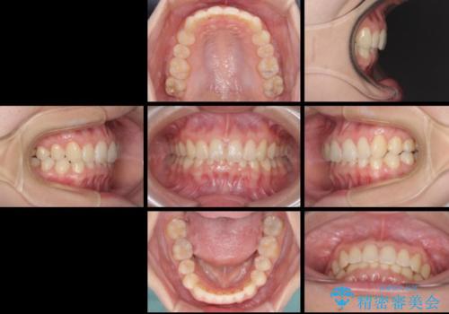 インビザラインによる前歯の矯正治療の治療後