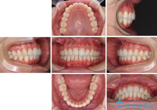 矯正治療の後戻りをインビザライン・ライトで改善の治療後