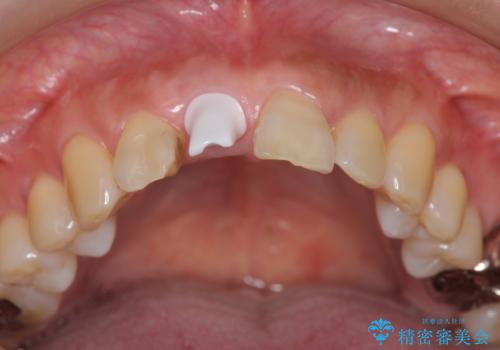 前歯 インプラントによる欠損補綴の治療中