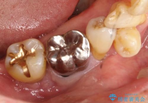 歯周病にて保存不可能な歯をショートインプラントで回復するの症例 治療前
