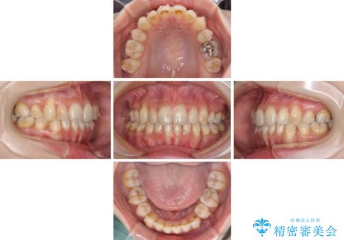 軽度な歯列不正 インビザライン・ライトによる矯正治療の治療中